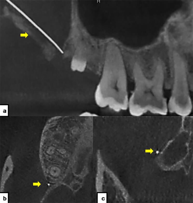 Fig 2. Tomografía computarizada. a: corte sagital; b: corte axial; c: corte coronal