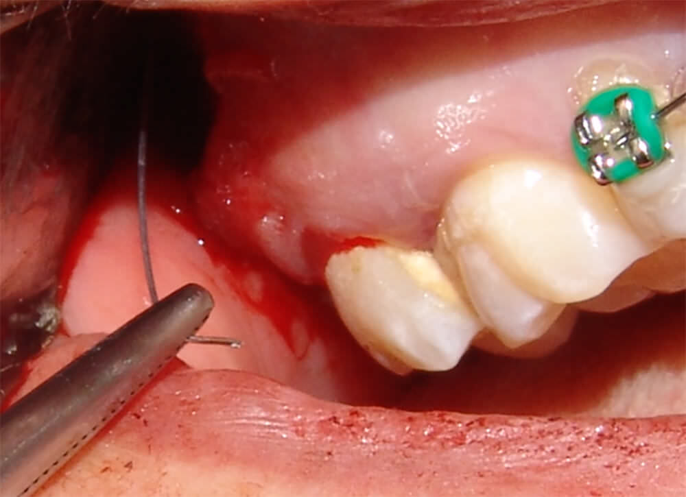 Fig 4. Retiro del fragmento de aguja fracturada con la ayuda de una pinza hemostática