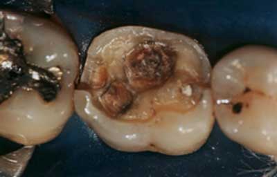 Figura 2 Antisepsia de la cavidad