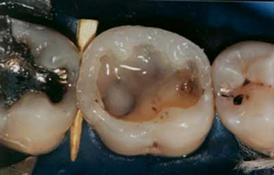 Figura 5 En esas condiciones la matriz pudo ser removida y así proceder a la restauración de la superficie oclusal, realizando un esbozo previo de la anatomía dental con caracterización del surco principal con un pigmento marrón Tetric color (Vivadent) en la parte interna de la resina compuesta. Finalizado el procedimiento restaurador, se removió el aislamiento absoluto y fueron verificados los puntos de contacto oclusal seguido de un refinamiento del tallado anatómico y acabamiento con fresas de 12, 24 e 30 láminas. (Figura 6)