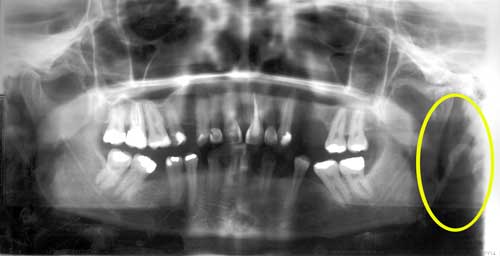 Fig. 1 Radiografía panorámica. Puede observarse el alargamiento y hosificación del proceso estiloide del lado izquierdo.