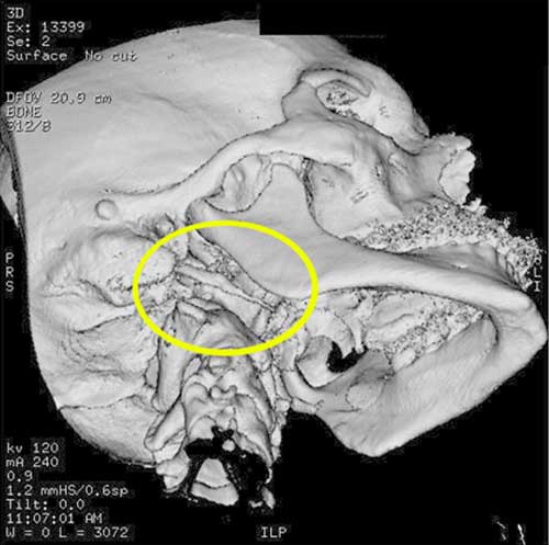 Fig. 2 Tomografía Computada con la reconstrucción tridimensional, donde se observan el alargamiento del proceso estiloide del lado derecho.