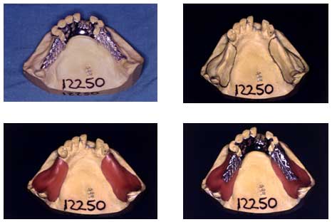 Figura 1 A. Estructura metálica sobre modelo. B. Diseño de la cubeta sobre modelo. C. Lamina de cera sobre área diseñada. D. Estructura metálica sobre la cera.
