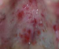 Fig 1. Lesiones erosivas en paladar
