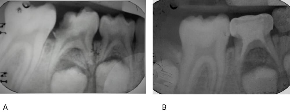 Figura 3 Radiografía periapical inferior derecha (A) inicio, (B) Final
