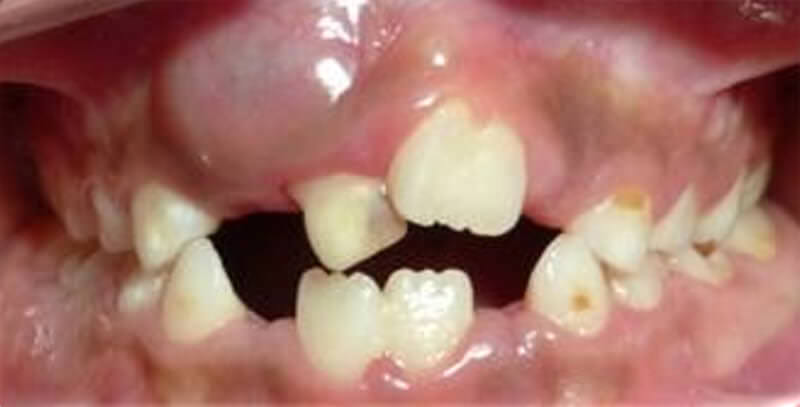 Imagen 1: Fotografía intraoral frontal
