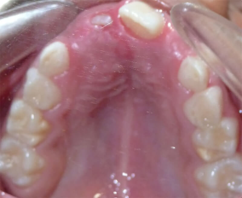 Imagen 13: Fotografía intraoral oclusal superior, a los seis meses