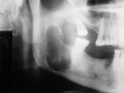 Fig. 2 Aproximación de la radiografía panorámica del lado derecho con 7 dias de post-operatorio, donde se puede observar la remoción del tercer molar inferior además de una imagen compatible con fractura a nivel del ángulo mandibular.