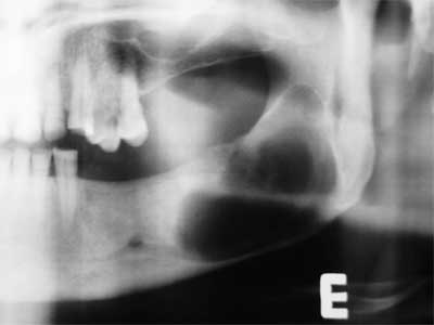 Fig. 3 Aproximación de la radiografía panorámica del lado izquierdo con 7 dias de post-operatorio, donde se puede observar la remoción del tercer molar inferior sin evidencia de perdida de la continuidad ósea.