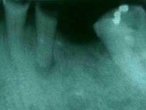 Figura 2: Estudio radiográfico en donde se puede observar la lesión periapical Tomado de: www.emedicine.com/ derm/topic767.htm