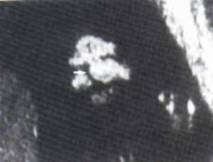Fotografía No. 2 Hendidura labial unilateral. Fuente: Callen P.