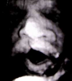 Fotografía No 4 Hendidura labiopalatina unilateral. Fuente: Callen P.