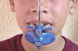 Fig. 4 Protracción maxilar con máscara facial.