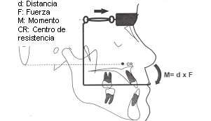 Fig. 7 Sistema de fuerzas y momento en el diseño de aparato extraoral de protracción reversa. Fuente: Alcan (2000)(37)