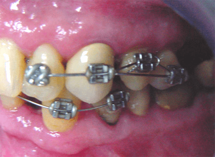 Fig. 8 Recementado del bracket