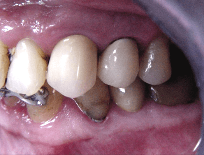 Fig. 14 Muñón artificial. Vista lateral