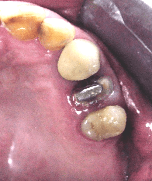 Fig. 15 Vista oclusal