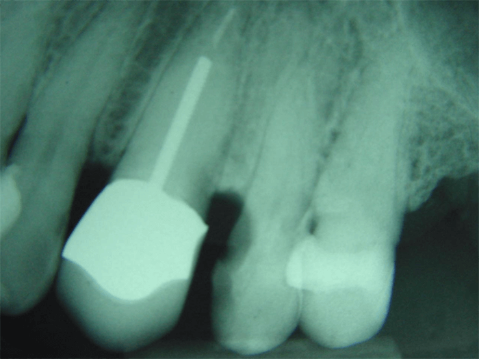 Fig. 18 Radiografía inicial