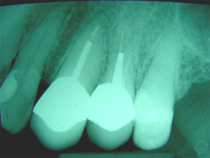 Fig. 19 Radiografía final