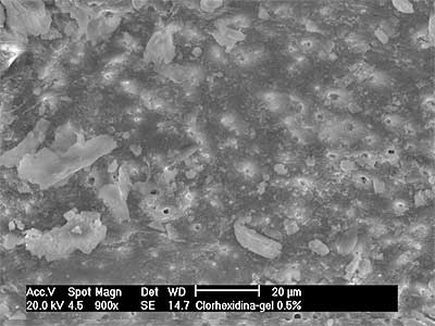 Fig. 1. Gel de clorhexidina al 0.5%. Tercio Medio.