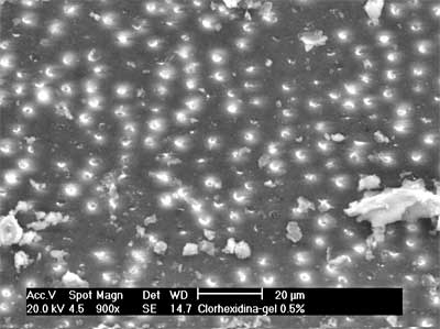 Fig. 5. Gel de clorhexidina al 0.5%. Tercio Apical