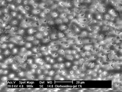 Fig. 6. Gel de clorhexidina al 1%. Tercio Apical