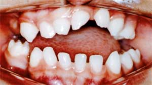 Figura 4- Con tres años y 6 meses de edad, los dientes deciduos erupcionados en la cavidad bucal, excepto los dientes 54, 55, 64, 84.