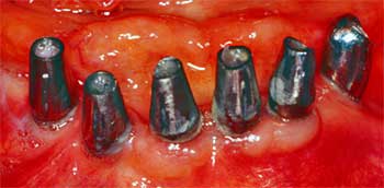 Figura 3. Implantes para carga protésica inmediata.