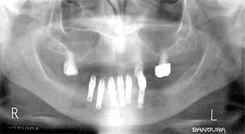 Figura 4. Radiografía a los 4 meses.