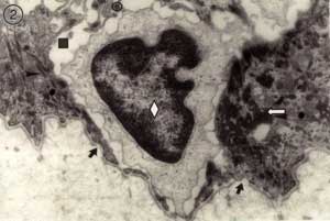 Fig. 2 Capa de células basales. Rombo: célula indiferenciada; flecha blanca: célula rica en tonofilamentos; cuadrado: espongiosis; círculo: desmosomas; fechas negras: membrana basal interrumpida.36000x