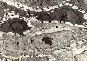 Fig. 3. Capa de células espinosas. Cuadrados: células con variaciones de electrondensidad; cabezas de fechas: tonofilamentos; círculos: mitocondrias; Nu: núcleolo; asterisco: espongiosis.10500x