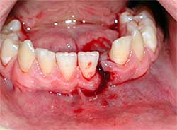 Fig. 1: Imagen clínica preoperatoria donde se evidencia el dislocamiento de la arcada dentaria asi como la comunicación entre la cavidad bucal y la fractura.