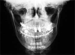 Fig. 10: Radiografía P.A frontal post-operatoria