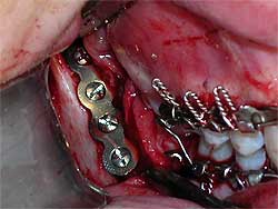 Fig. 5: Reducción y FIR de la fractura de ángulo mandibular por medio de la técnica descrita por Champy.