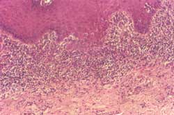 Figura 4 - Aspecto histológico del LPO con gran infiltrado subepitelial de células mononucleares dispuesto en "forma de faja" y destrucción de la capa basal epitelial (hematoxilina y eosina - 200x).