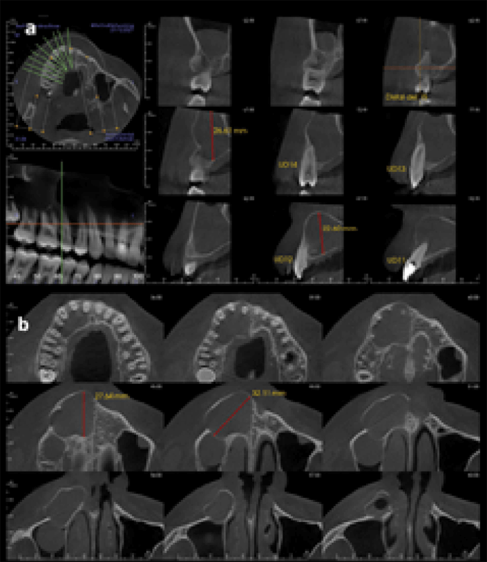 Figura 3. CBCT inicial. (a) cortes sagitales secuenciales de la UD 1.1 (b) cortes axiales secuenciales maxilar superior.
