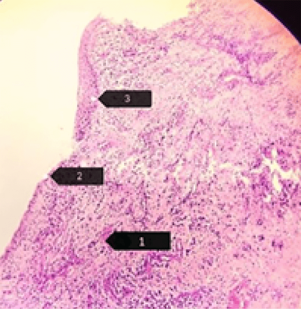 Figura 7: Corte Histopatológico 1) Pared de estructura quística constituida por tejido conectivo fibroso, vasos sanguíneos e infiltrado inflamatorio. 2) Superficie epitelial erosionada o ausente. 3) Epitelio plano estratificado constituido por 3 a 5 células de espesor.