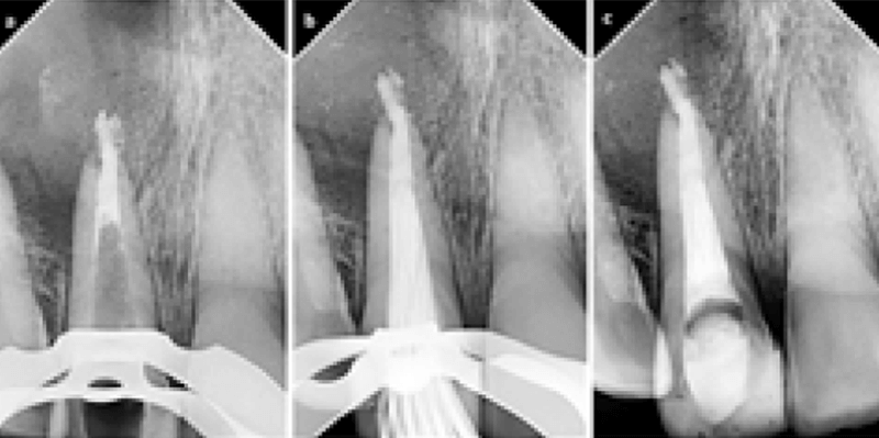 Figura 8. (a) Radiografía de la apexificación, (b) sellado apical con biocerámico, (c) obturación post inmediata.