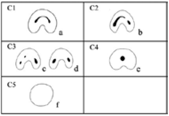 Figura 1. Clasificación morfológica del sistema de conductos en “C” en segundos molares mandibulares según Fan et al. C1: conducto en “C” continuo; C2: semilunar o “C” interrumpida; C3c/C3d dos o tres conductos separados; C4: un solo conducto redondo; C5: sin lumen visible. Reproducido/adaptado de Fan et al. 2004 3.