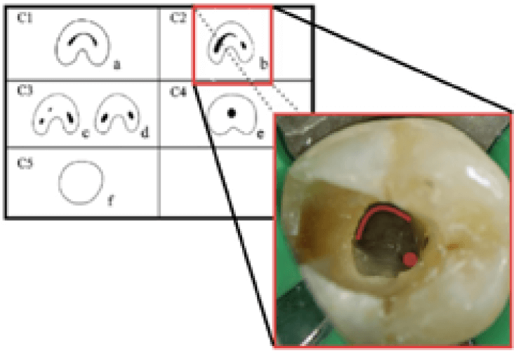 Figura 3. Identificación clínica del sistema de conductos en “C” clase II según Fan, con localización de los conductos mesial y distal comunicados por un istmo continuo.