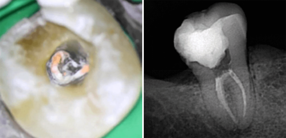 Figura 5. Conducto en C obturado clínicamente, documentado mediante imagen fotográfica bajo microscopio y radiografía periapical.