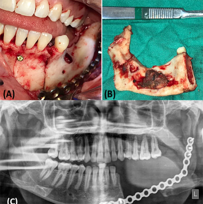 Figura 8. (A) Exposición quirúrgica de la lesión a través de abordaje intraoral. Colocación y fijación de placa de reconstrucción precontorneada. (B) Vista mascroscópica de bloque mandibular. (C) Ortopantomografía postoperatoria con placa de reconstrucción en posición.