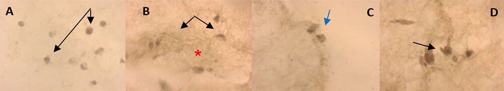 FIGURA 2. Células mesenquimales de la pulpa dentaria humana inmersas en la matriz natural de colágeno tipo I, a los veintiún días de inducción odontogénica-osteogénica. Expresión de la DSP, análisis inmunohistoquímico. A. Cultivo “control”, las células permanecen redondeadas, algunas células expresan la DSP (flecha negra). 400x. B. C. y D. Cultivo “Inducido a la diferenciación”, las células (flechas negras) y la matriz (*) expresan la DSP, se observan cambios morfológicos (flechas azules) y la matriz muestra cambios notables, se observa más fibrosa. 400x