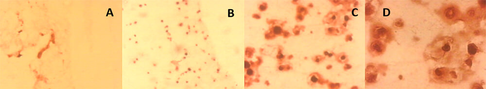 FIGURA 3. Células mesenquimales de la pulpa dentaria humana inmersas en la matriz de colágeno tipo I, veintiún días de inducción odontogénica-osteogénica. Coloración histoquímica con Rojo Alizarina. A. Cultivo “control”, pocas células rodeadas de matriz. 100x. B. Cultivo “inducido a la diferenciación”, se observan numerosas nódulos calcificados inmersos en la matriz. 100x. C. Mayor aumento, se observan nódulos calcificados y zonas difusas de mineralización. 200x. D. Mayor aumento, células rodeadas de matriz mineralizada de fosfato de calcio. 400x