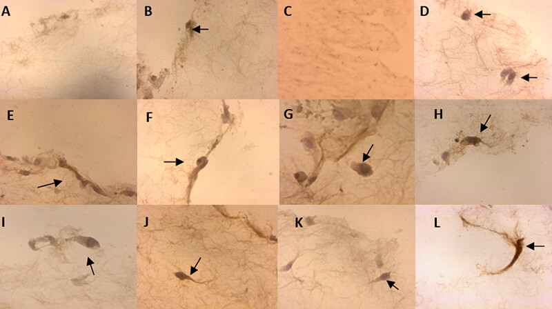 FIGURA 5. Células mesenquimales de la pulpa dentaria humana sobre la matriz de colágeno tipo I, catorce y veintiún días de inducción odontogénica-osteogénica. Expresión de la DSP, análisis inmunohistoquímico. Catorce días: A. Cultivo “control”, muy pocas células, se observó expresión de la DSP.100x. B. Cultivo “inducido a la diferenciación”, células con cambios morfológicos que expresan la DSP, (flecha). 400x. Veintiún días: C. Cultivo “control”, se observa la matriz con pocas células. 40x. D. Mayor aumento, células con cambios morfológicos y expresión de la DSP, (flecha). 400x. E, F, G, H, I, J, K, y L. Cultivo “inducido a la diferenciación”, células con cambios morfológicos que expresan la DSP (flechas). La matriz se observa densa y fibrosa.400x
