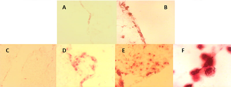FIGURA 6. Células mesenquimales de la pulpa dentaria humana sobre la matriz de colágeno tipo I, catorce y veintiún días de inducción odontogénica-osteogénica. Coloración histoquímica con Rojo Alizarina. Catorce días: A. Cultivo “control”, muy pocas células, una zona pequeña con marcaje.100x B. Cultivo “inducido”, se observan algunos pequeños nódulos calcificados. 200x. Veintiún días: C. Cultivo “control”, algunas zonas Rojo Alizarina “positivas”. 100x. D. y E. Cultivo “inducido”, numerosos nódulos calcificados. 100x. F. Mayor detalle, células rodeadas de matriz mineralizada de fosfato de calcio. 400x
