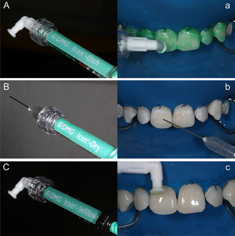 Figura 2 Imagen del Sistema ICON y su aplicación. Aislamiento con dique de goma natural. A/a. La jeringa con gel acido permite ensamblar una punta aplicadora del sistema que permite una cómoda aplicación del gel sobre las superficies dentales, luego de 120 s de acondicionamiento, el gel debe ser profusamente lavado por 30 s; B/b. La jeringa de etanol posee una aguja de aplicación. Sobre las superficies deshidratadas es aplicado el etanol por 30 s y secado con aire; C/c. La resina infiltrante es aplicada dejándola actuar por 3 min, los excesos deben ser removidos antes de la fotoactivación por 40 s y luego se realizar un replicación por 1 min.