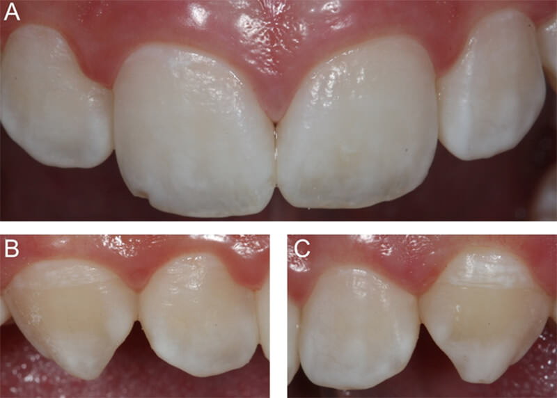 Figura 4 Vista final luego de 1 semana. A - C. Observe el enmascaramiento del las machas de fluorosis y homogenización del aspecto general.