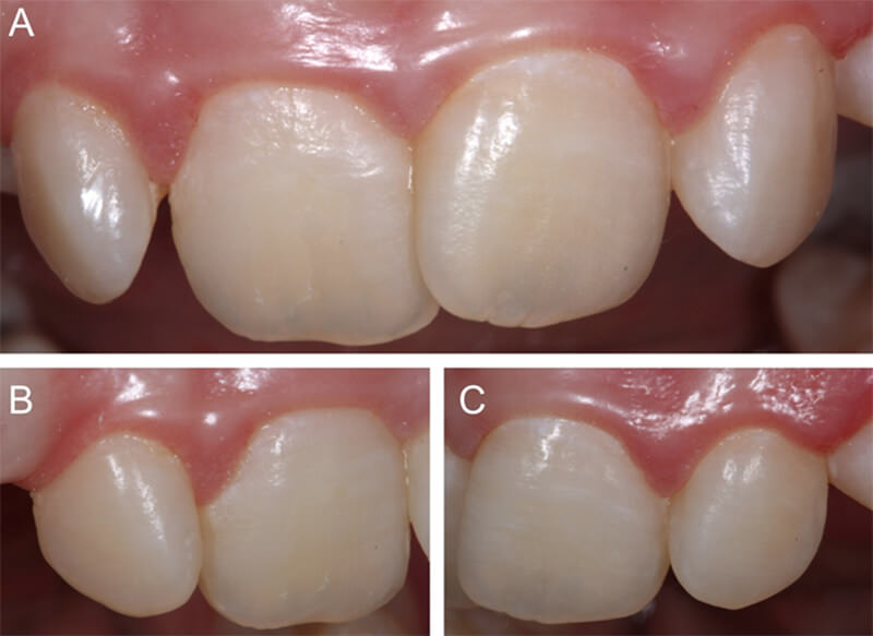 Figura 6 Vista final luego de 1 semana. A - C. Observe el enmascaramiento del las machas de fluorosis y homogenización del aspecto general.