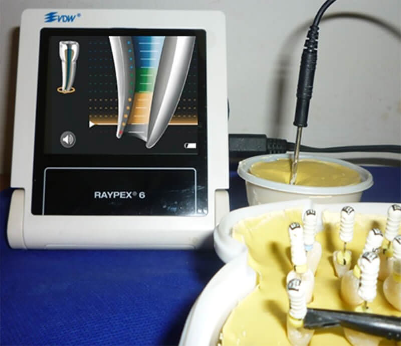 Foto 5. Medición de la longitud de trabajo con el localizador de ápices Raypex 6.